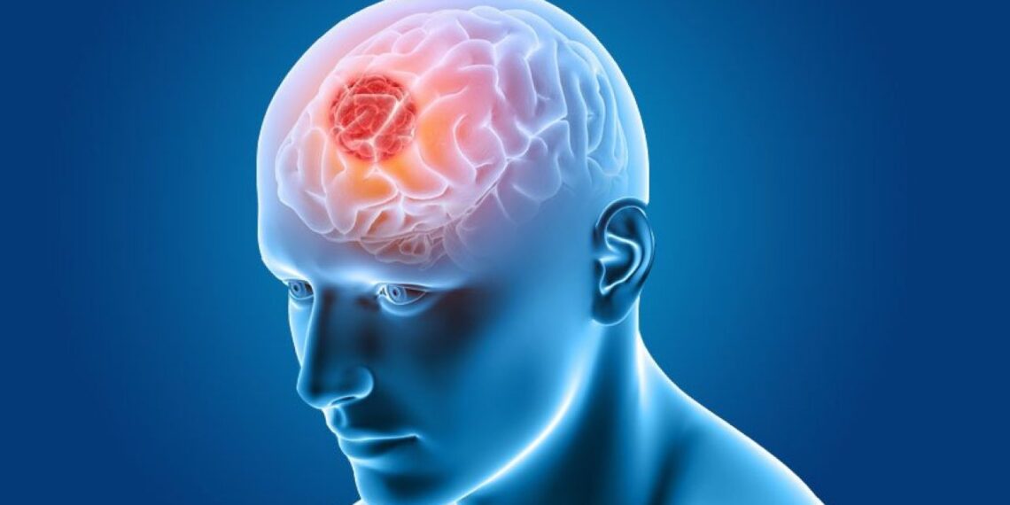 6 Reasons Why Brain Tumors Affect Your Vision Hospitalninojesus