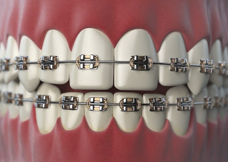 Myths About Dental Braces Hospitalninojesus