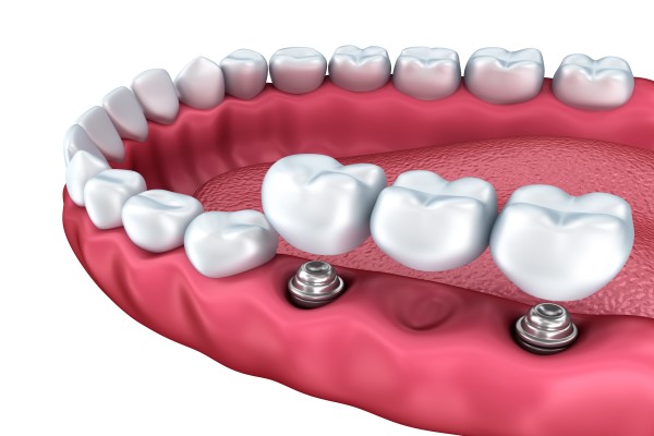 Dental Bridges