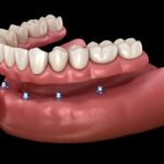 Implant supported dentures in King of Prussia, PA