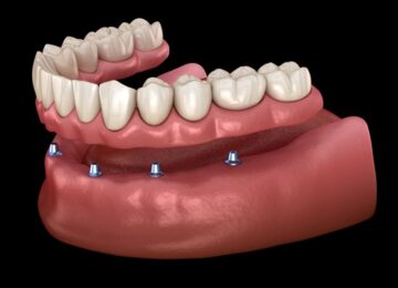 Implant supported dentures in King of Prussia, PA