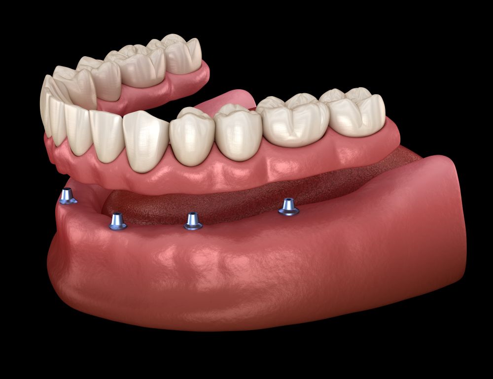 Implant supported dentures in King of Prussia, PA